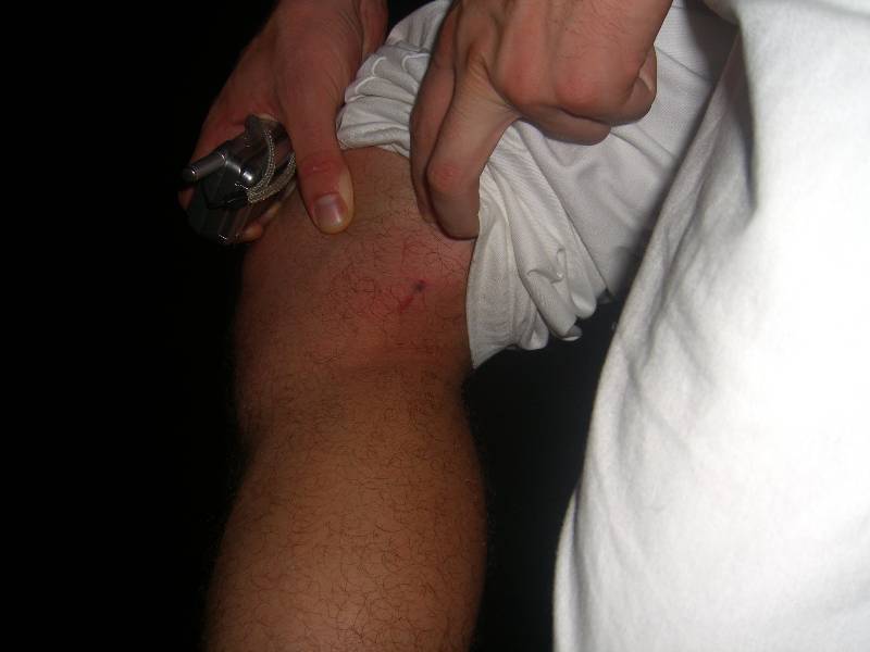 CIMG1325 That's where coco bit me